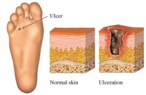 What causes diabetic foot sores