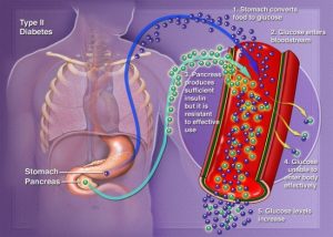 what is type ii diabetes