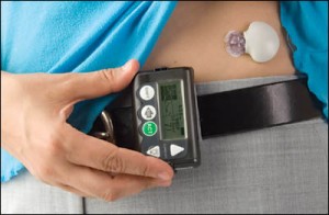 continuous blood glucose monitoring