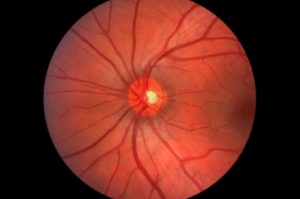 stages of diabetic retinopathy