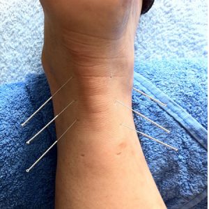 Acupuncture Therapy For Diabetes