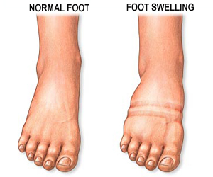 diabetes foot swelling